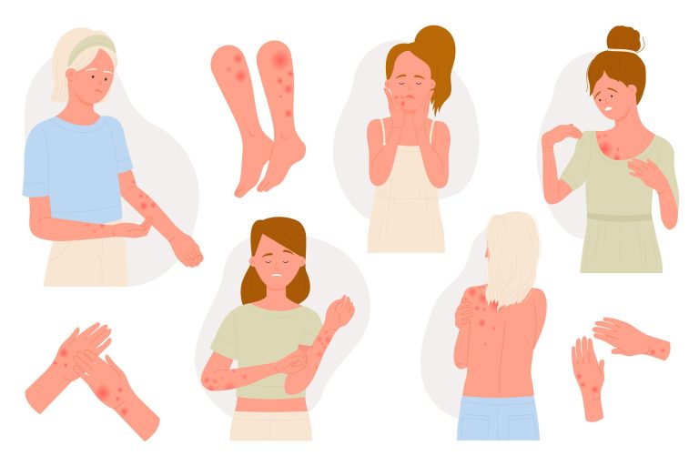 Dealing With Body Acne