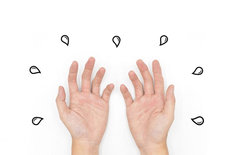 What Is Hyperhidrosis?