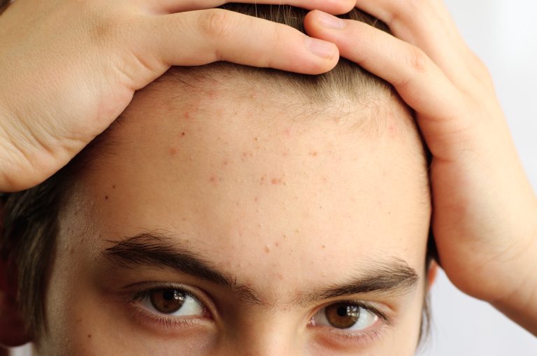 Athletes: How To Beat Forehead Breakouts